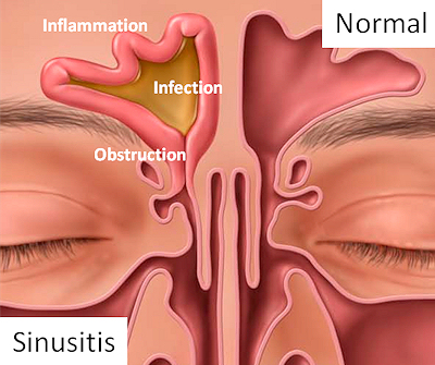 SinusitisPicturesmall