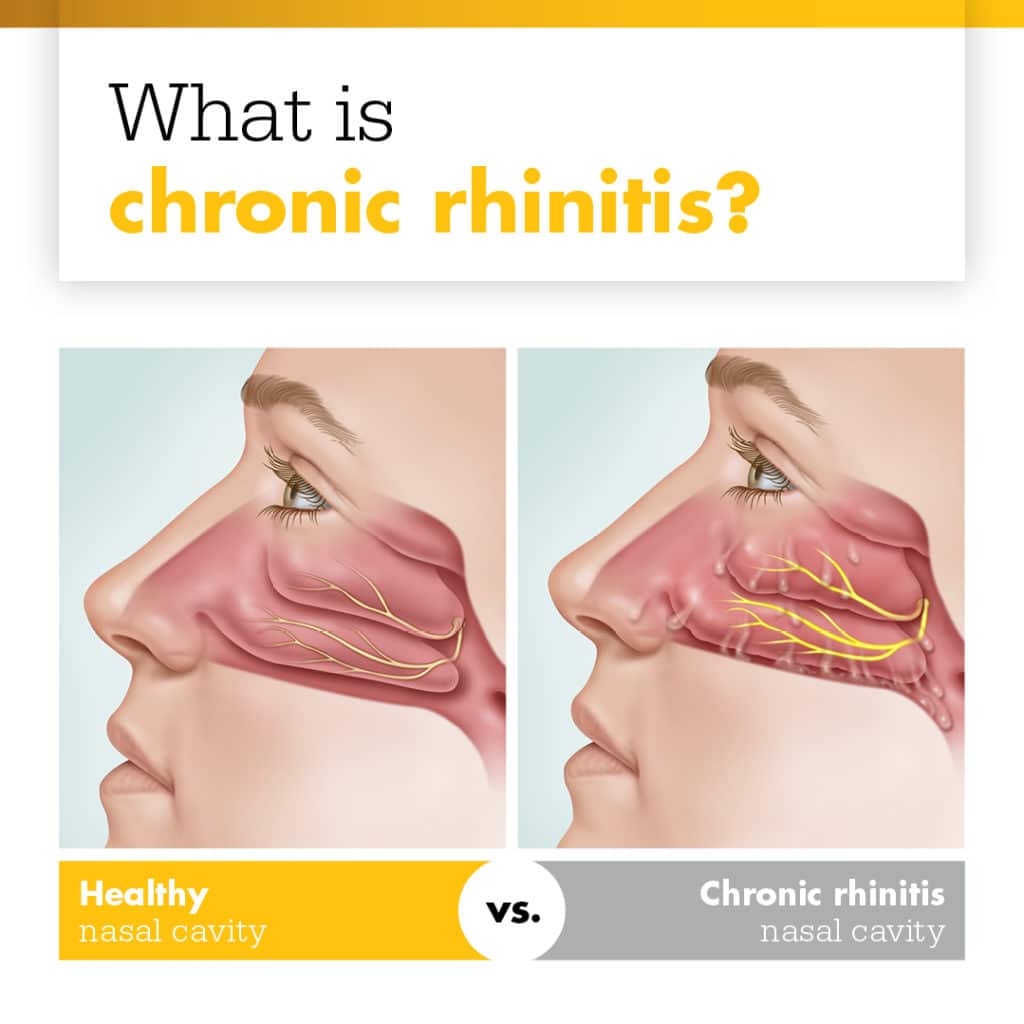 Rhinitis - What Is It